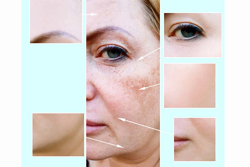 Tackling pigmentation from age spots, sun damage and hormonal changes