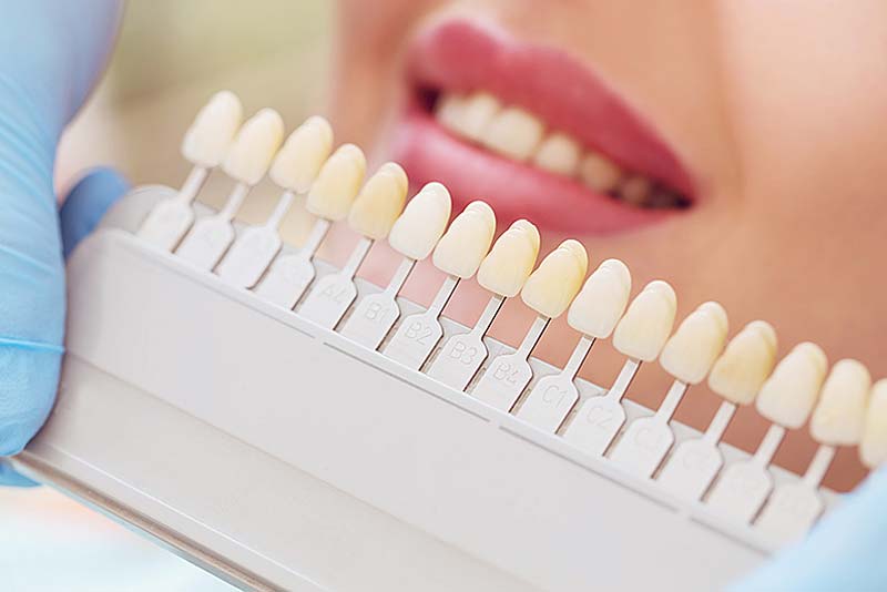 Dental Implants, Crowns