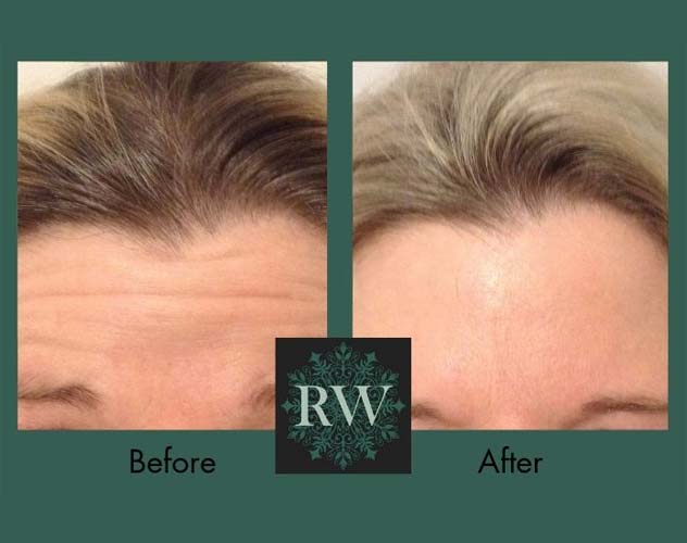 RW skin treatment before and after photo